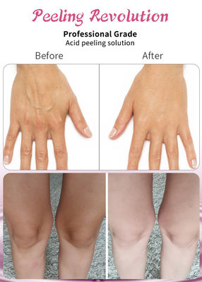고품질 피부 벗기 세럼 은 콜라겐 재생 을 촉진 하고 피부 를 돋보인다