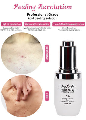 껍질 껍질 껍질 껍질 벗기 용액 여드름 제거 피부 관리 피부 벗기 30ml