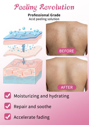 껍질 껍질 껍질 껍질 벗기 용액 여드름 제거 피부 관리 피부 벗기 30ml