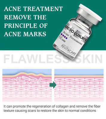 여드름 흉터를 위한 치료 Mesotherapy를 희게하는 순수한 식물 여드름 공간 혈청