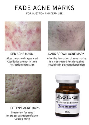 호화스러운 젊음 혈청 주입 Mesotherapy 붉은 반점 피부 여드름 주입 처리