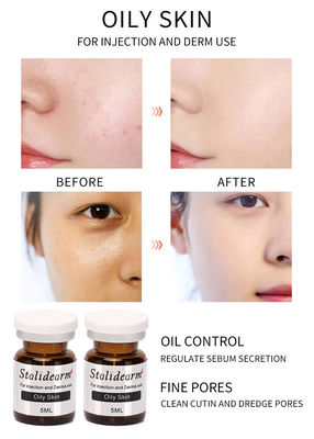 메소 테라피 솔루션 엑소섬 치료 기름진 피부 치료 피부 부스터 주사 세럼 고품질 프랑스 원본 스탈리드어름 브랜드